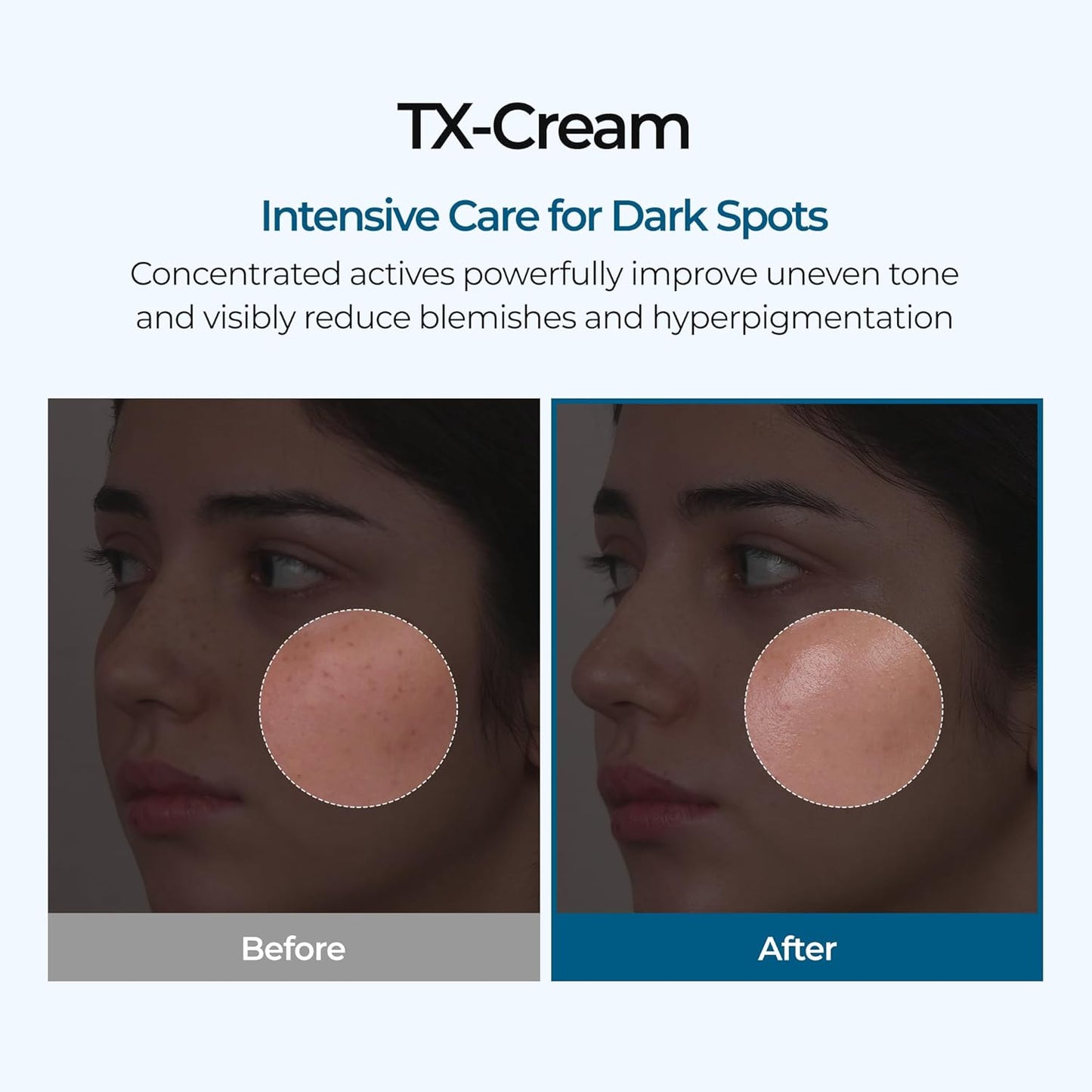 TX Tranexamic Acid Cream